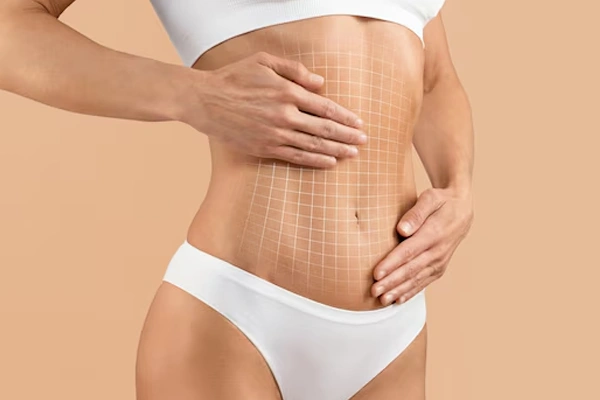 Tummy Tuck