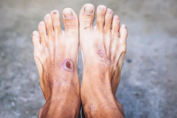 Diabetic Foot Salvage