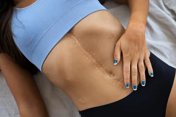 Scar Revision